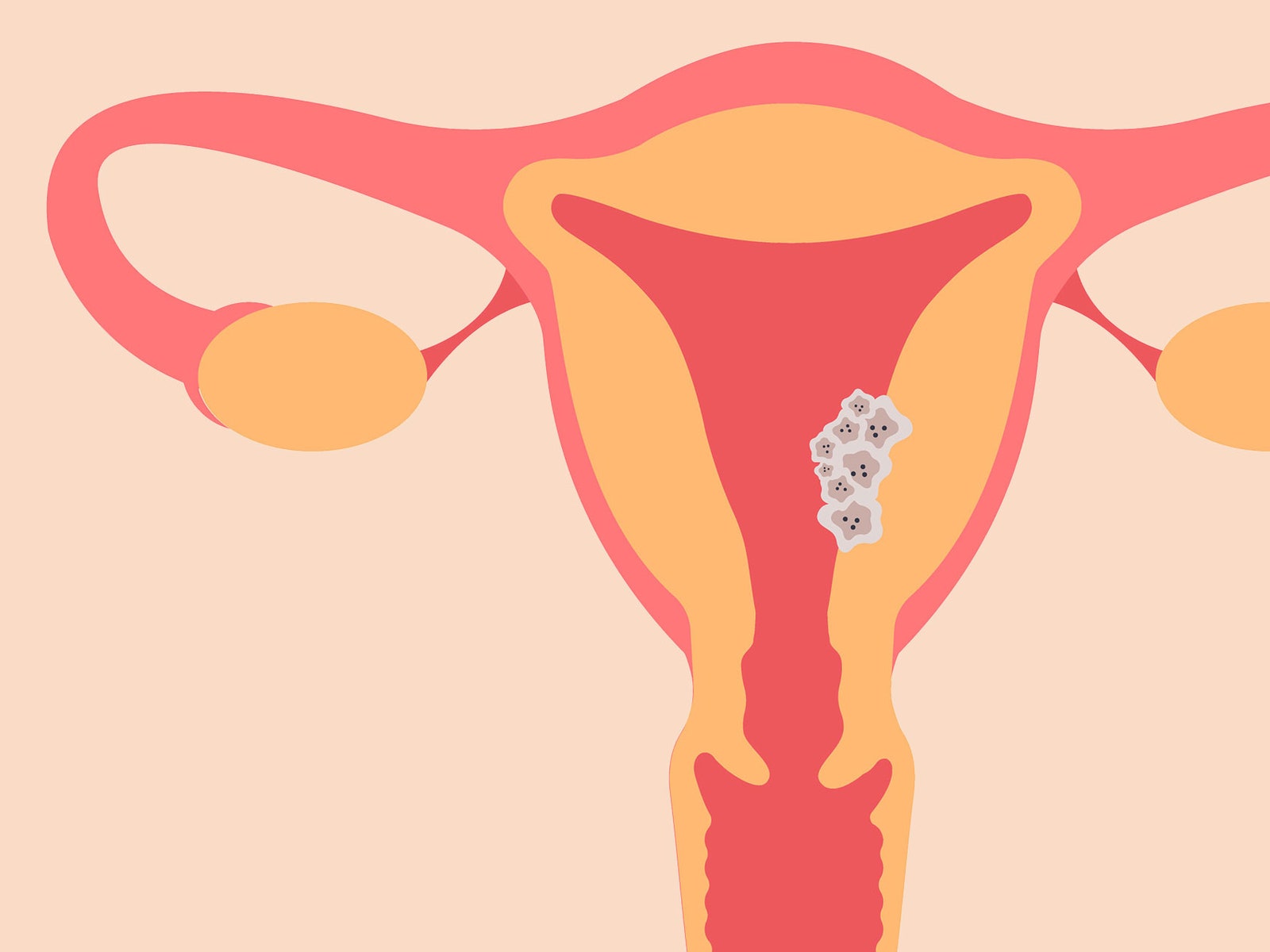 Can you name the five gynaecological cancers? Here's what you need to know